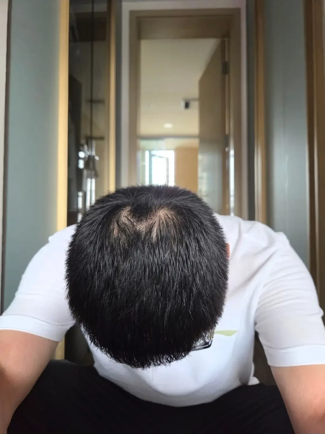 培建米诺地尔使用一年后感受