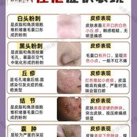 痤疮分5类：白头粉刺、黑头应对方法大不同