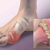 骨病科普 | 关节痛与年龄的关系对照，需警惕这些疾病
