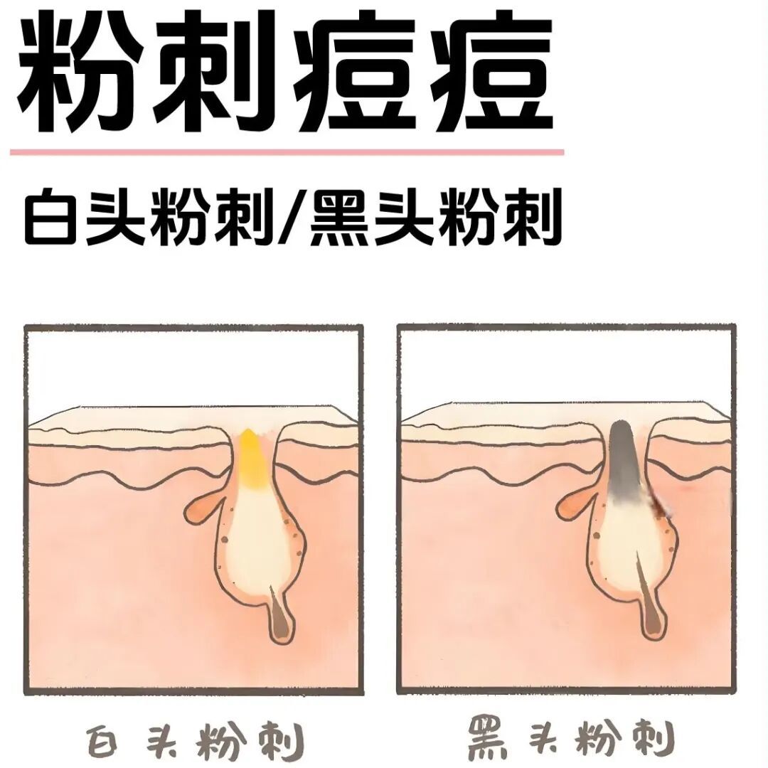 战 “痘” 全攻略|从成因到解决,科学护肤不踩坑