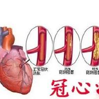 速效救心丸、麝香保心丸和丹参滴丸的区别