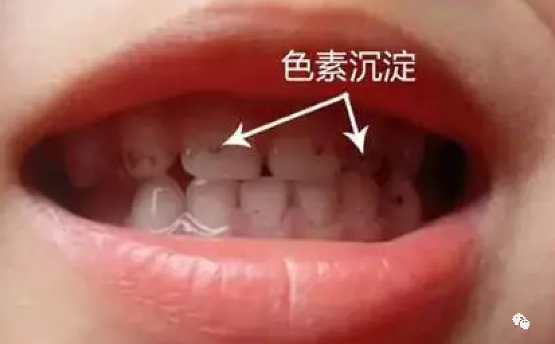 【常识】小朋友为什么有“小黑牙”?