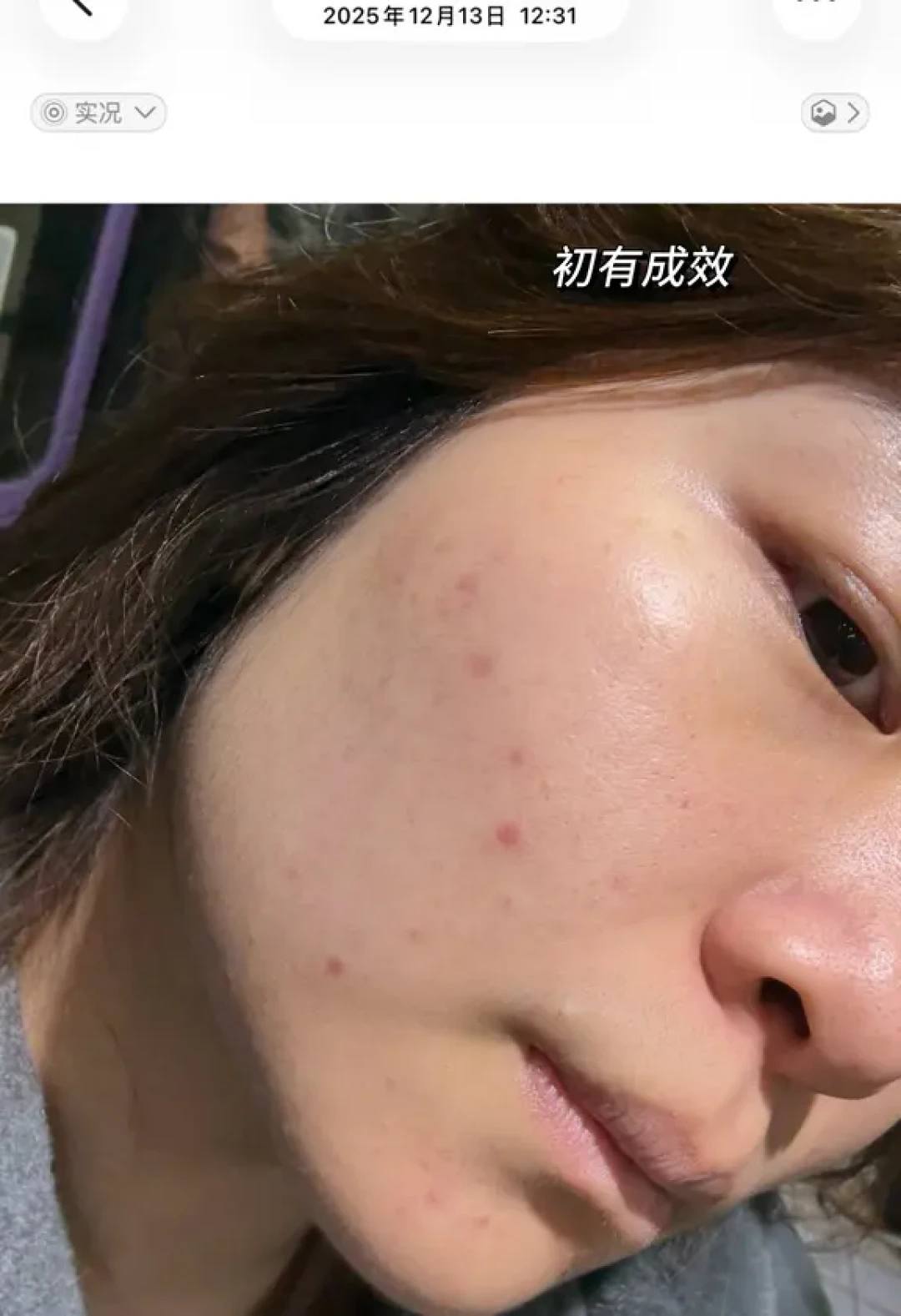 阿达帕林|从恨到爱只需要一个月