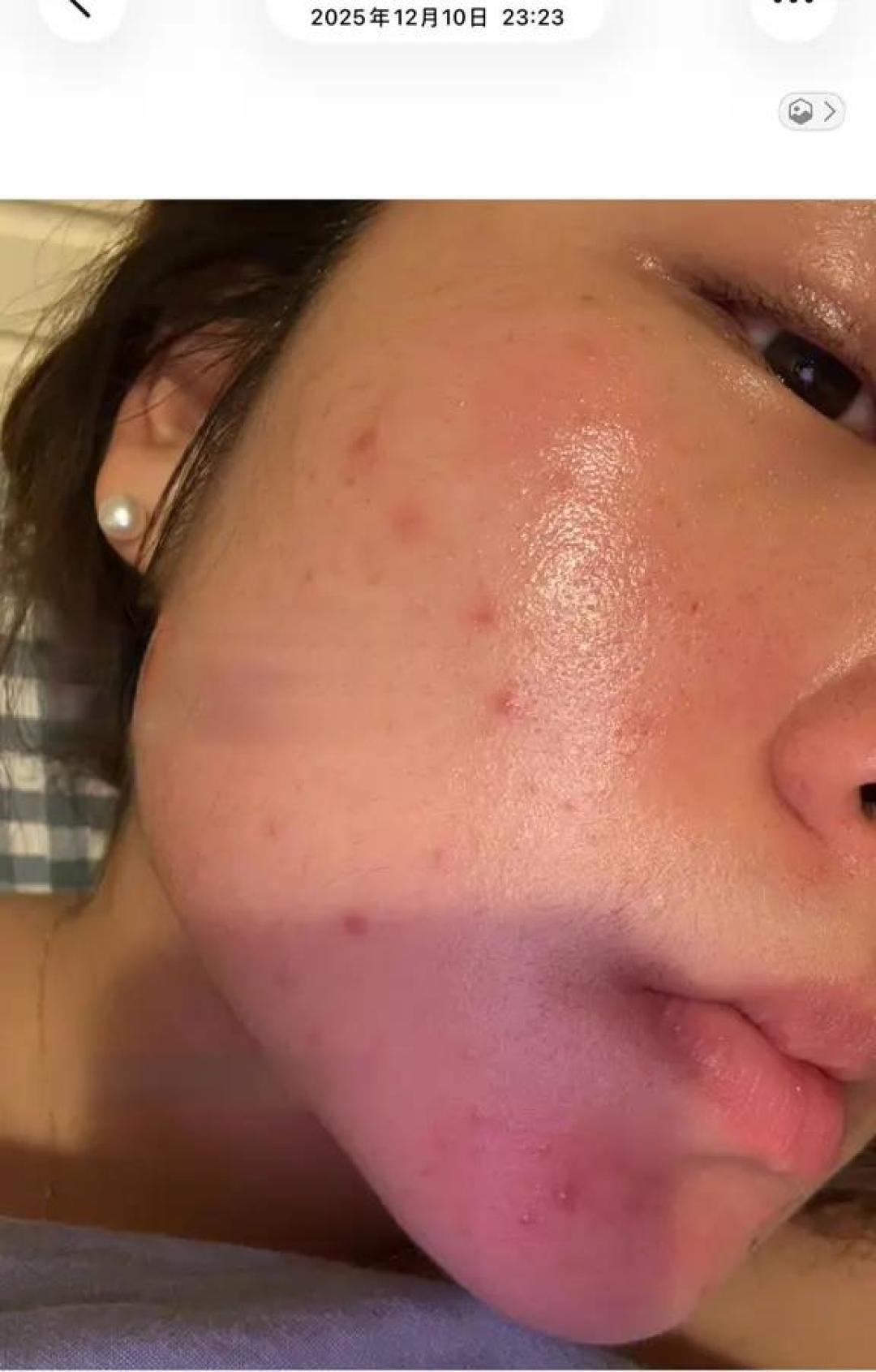 阿达帕林|从恨到爱只需要一个月