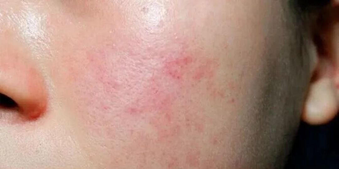 别把“激素脸”当“敏感肌”!修复方法大不同!