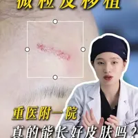 什么是环钻微粒皮移植？它适合哪些疤痕呢！ #微粒皮移植 #瘢痕修复 #抖出健康知识宝藏 #重医附一院 #疤痕增生