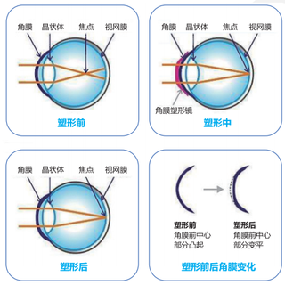 库博MiSight是儿童近视防控最优解吗？728+用户观点大PK