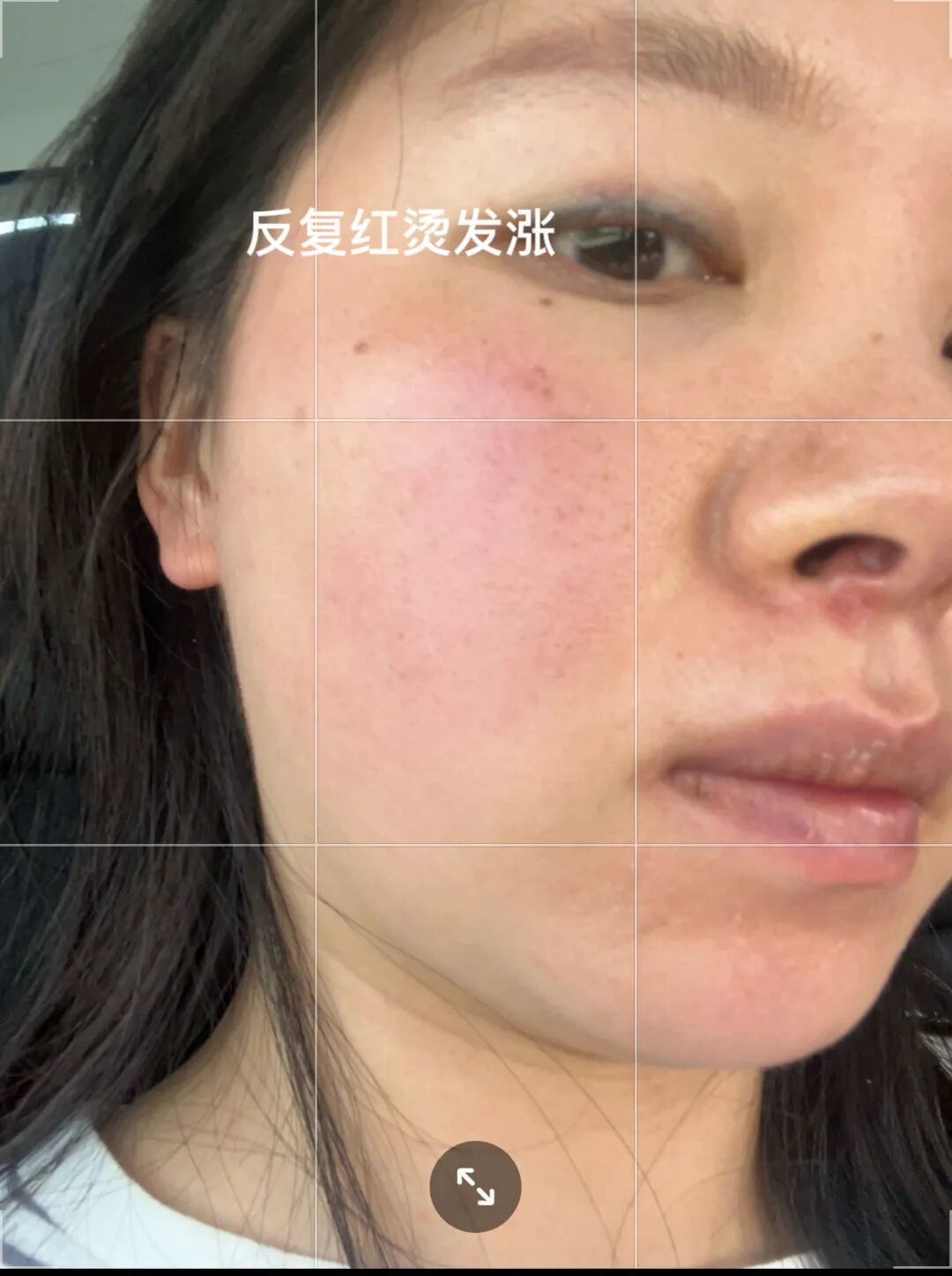 十年激素脸终结篇(小香)我们终于恢复正常人了