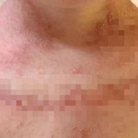 “仿佛是僵尸”！浙江两家人接连中招，大人小孩皮肤“报废”！元凶找到了