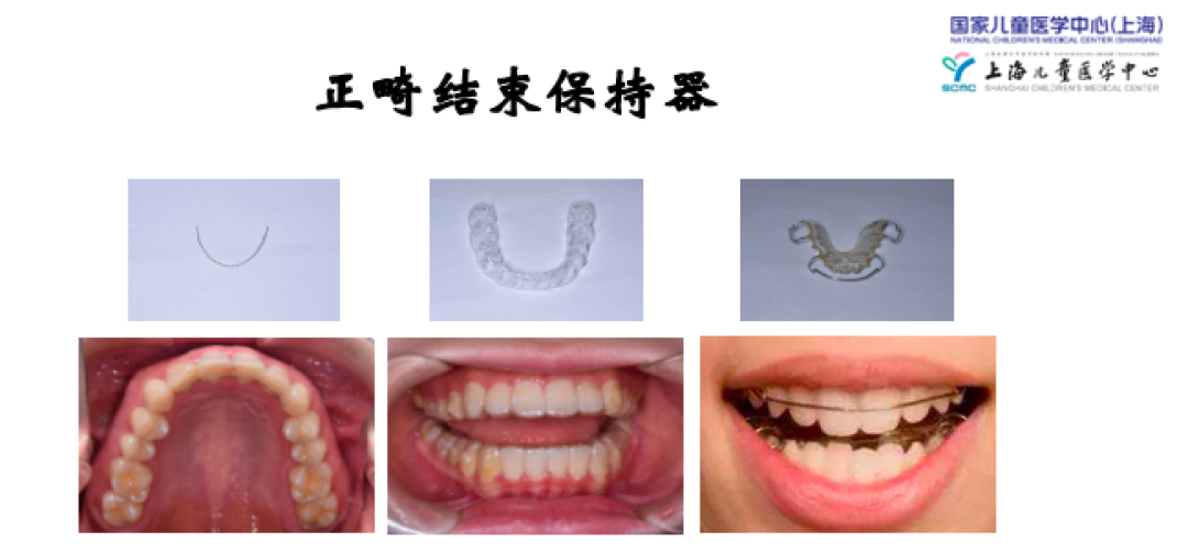 【儿童口腔科普知识】固定金属矫治器注意事项