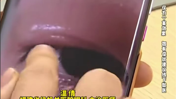 女子戴蒸汽眼罩睡觉：双眼视力1.2跌至0.6
