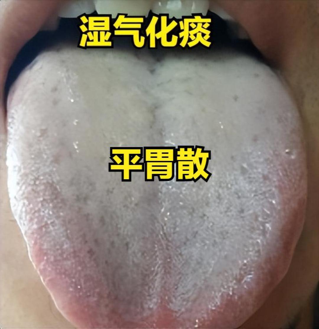中医舌诊：如何识别湿气的四个阶段并调理