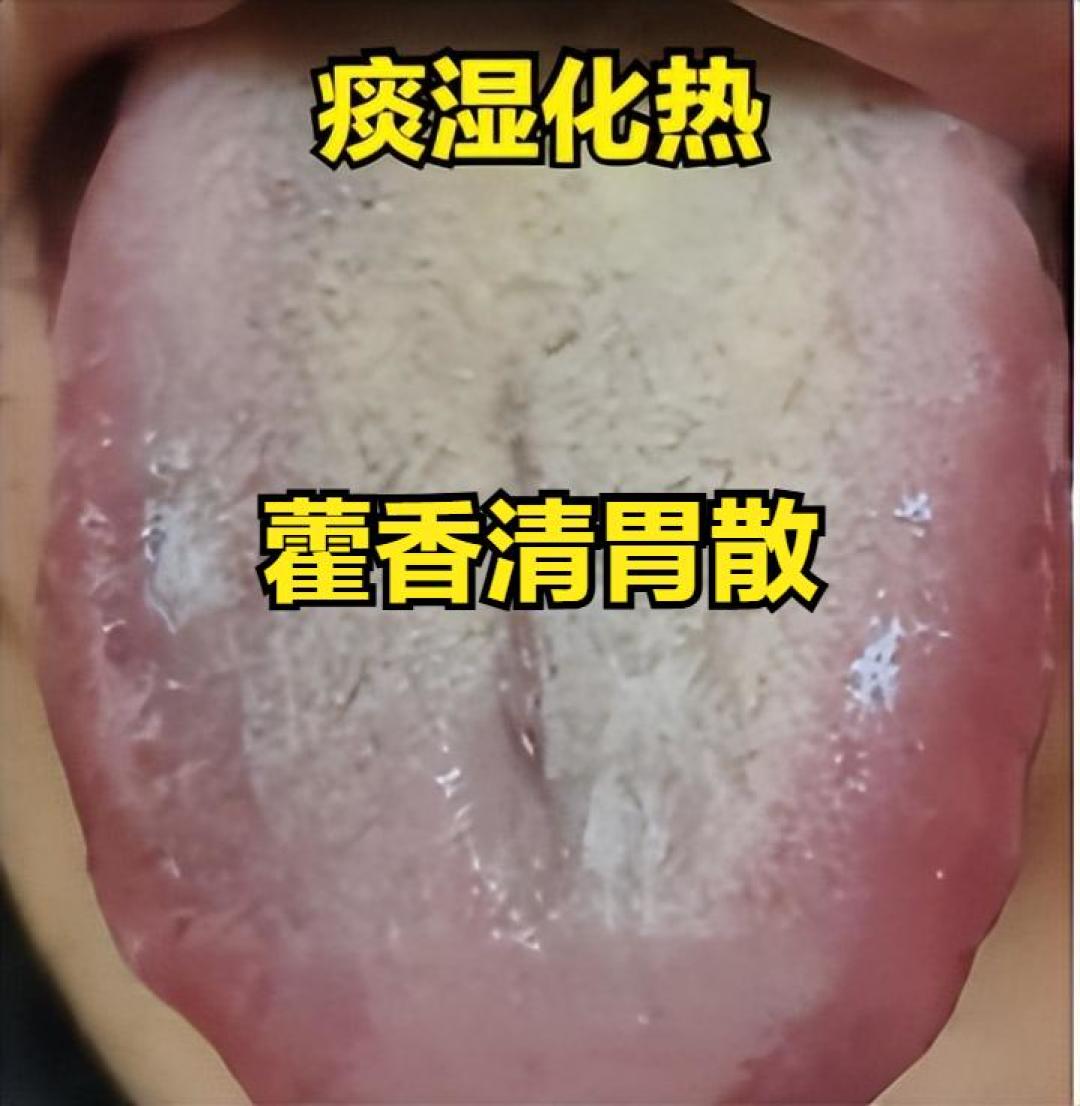 中医舌诊：如何识别湿气的四个阶段并调理