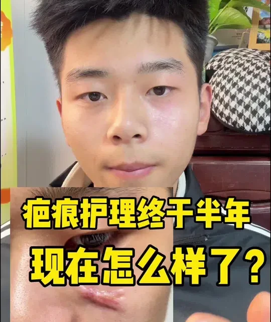 疤痕护理终于半年了现在怎么样了？#疤痕#疤痕护理