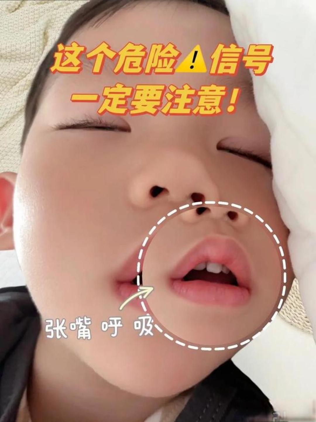 孩子嘴唇总是往上翘,是“腺样体面容”吗?