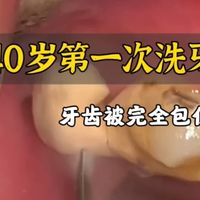 处理及时,你也可以不长牙结石!Dr.Sun科普时间:牙结石究竟怎么来的?