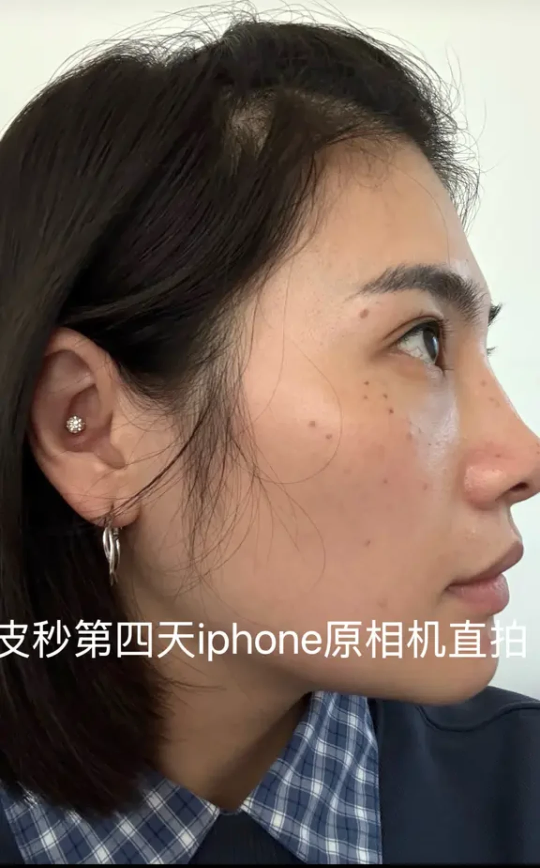 变美日记——拒绝反黑!皮秒一周恢复记录