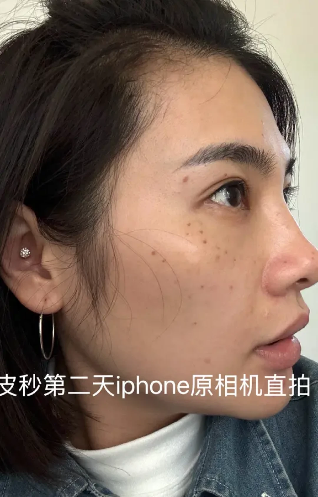变美日记——拒绝反黑!皮秒一周恢复记录