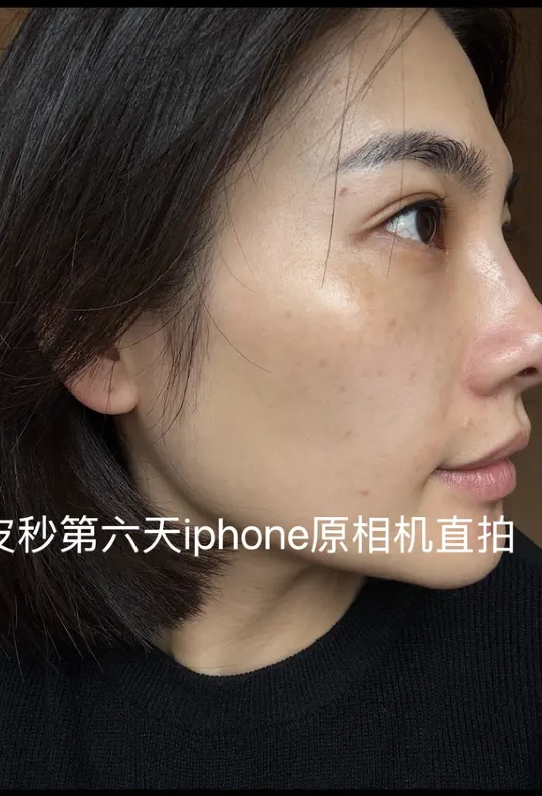 变美日记——拒绝反黑!皮秒一周恢复记录