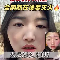 #敏感红烫肌 火是怎么形成的？到底要怎么灭火#皮肤发红发烫 #遇热发红发烫 #屏障受损修复 #长疹子