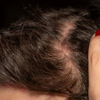 别只盯ZPT！去屑成分选错反伤头皮，二硫化硒与酮康唑的适用场景大不同