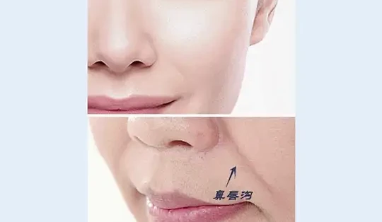 面部注射攻略：苹果肌/鼻唇沟，选哪种产品更好？ 了解清清楚楚，变美安安心心！ #医学科普 #苹果肌 #法令纹 #鼻唇沟 #内容过于真实_面部 ...