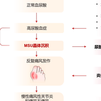 兼顾止痛与防复发：何种方案能为痛风快速带来长久安心？
