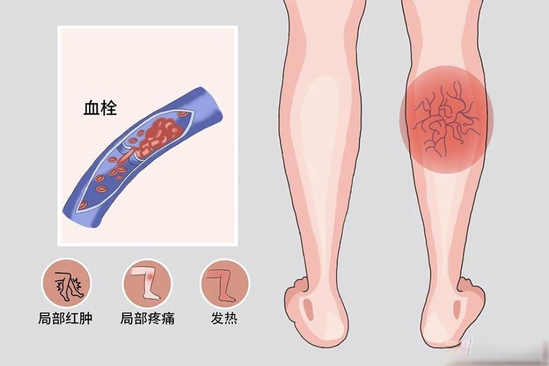 春节回家坐到腿肿?一个“黄金动作”坐着就能防血栓