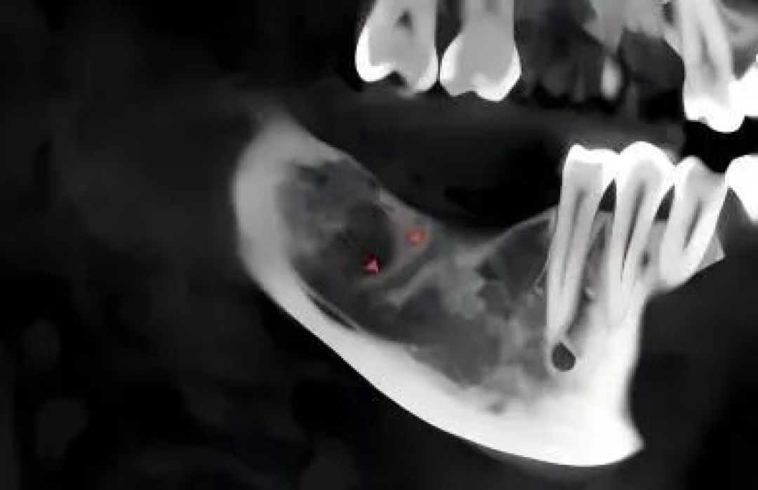 血管的分支？愈合的间隙？牙槽外科术后愈合影像3例