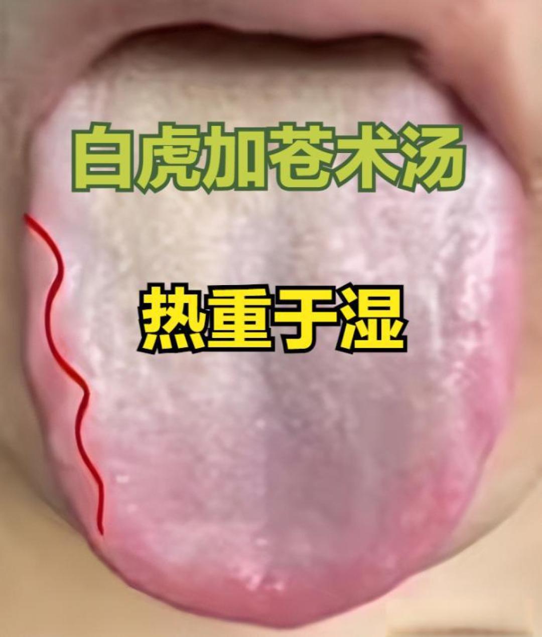 辨清湿热舌象三大类型,祛湿事半功倍