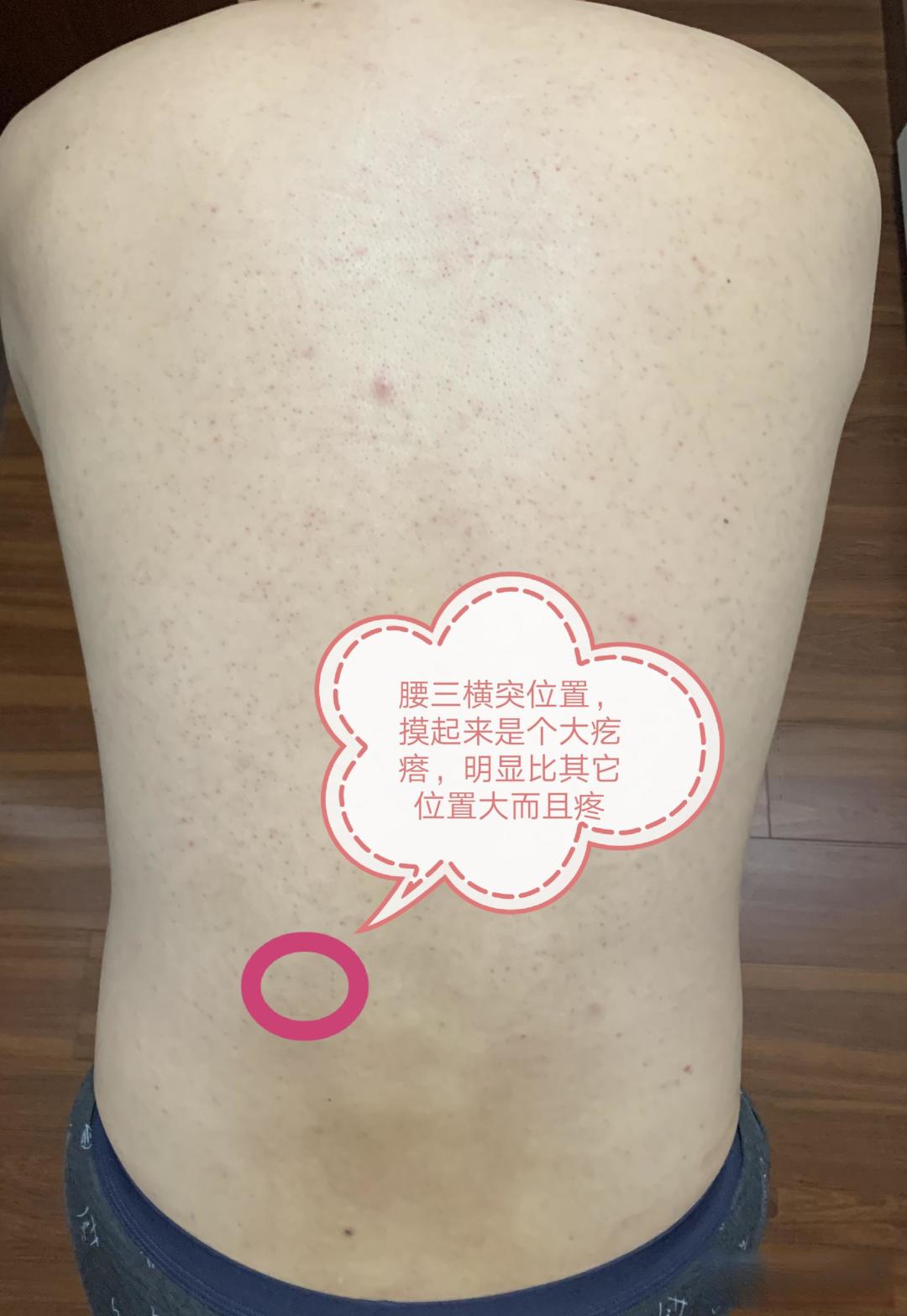 常见腰部问题详解➕康复训练