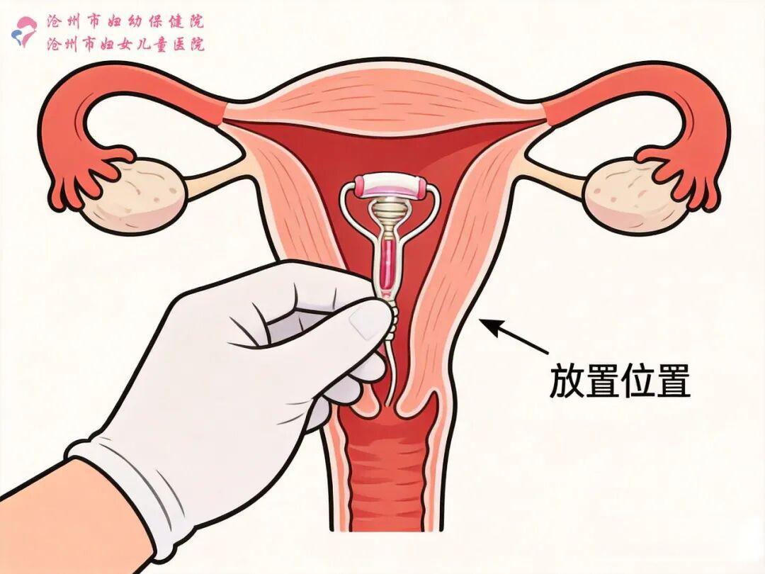 六大科学避孕方式祝您:爱得尽兴,爱得安全