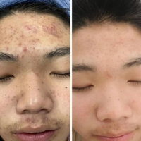 安修泽油橄榄精华：痘肌救星还是营销神话？全网真实口碑大起底
