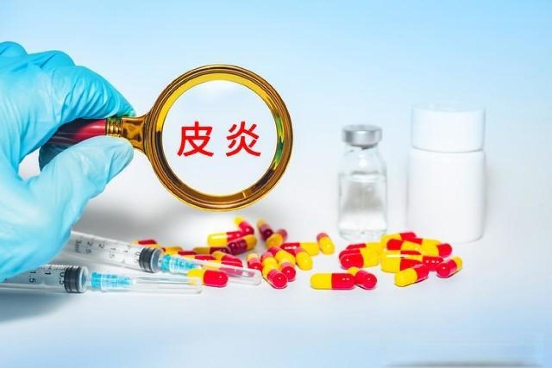如何科学调理头皮脂溢性皮炎?中西结合康复全攻略