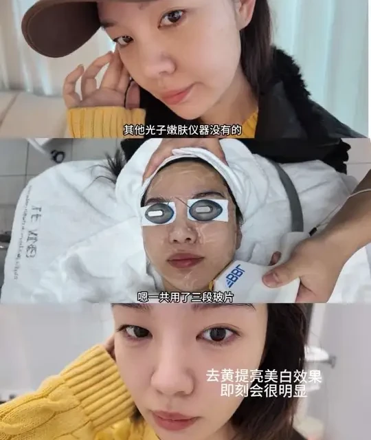 年前三件套之医美 最后一件完成✅
#医美