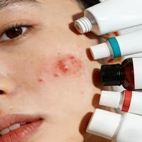 水杨酸强效疏通毛孔，壬二酸稳控炎症痘印：油痘肌该选谁？