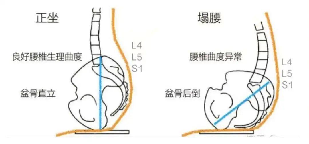除了卷腹,还有哪些动作可以有效锻炼核心肌群,保护腰椎?