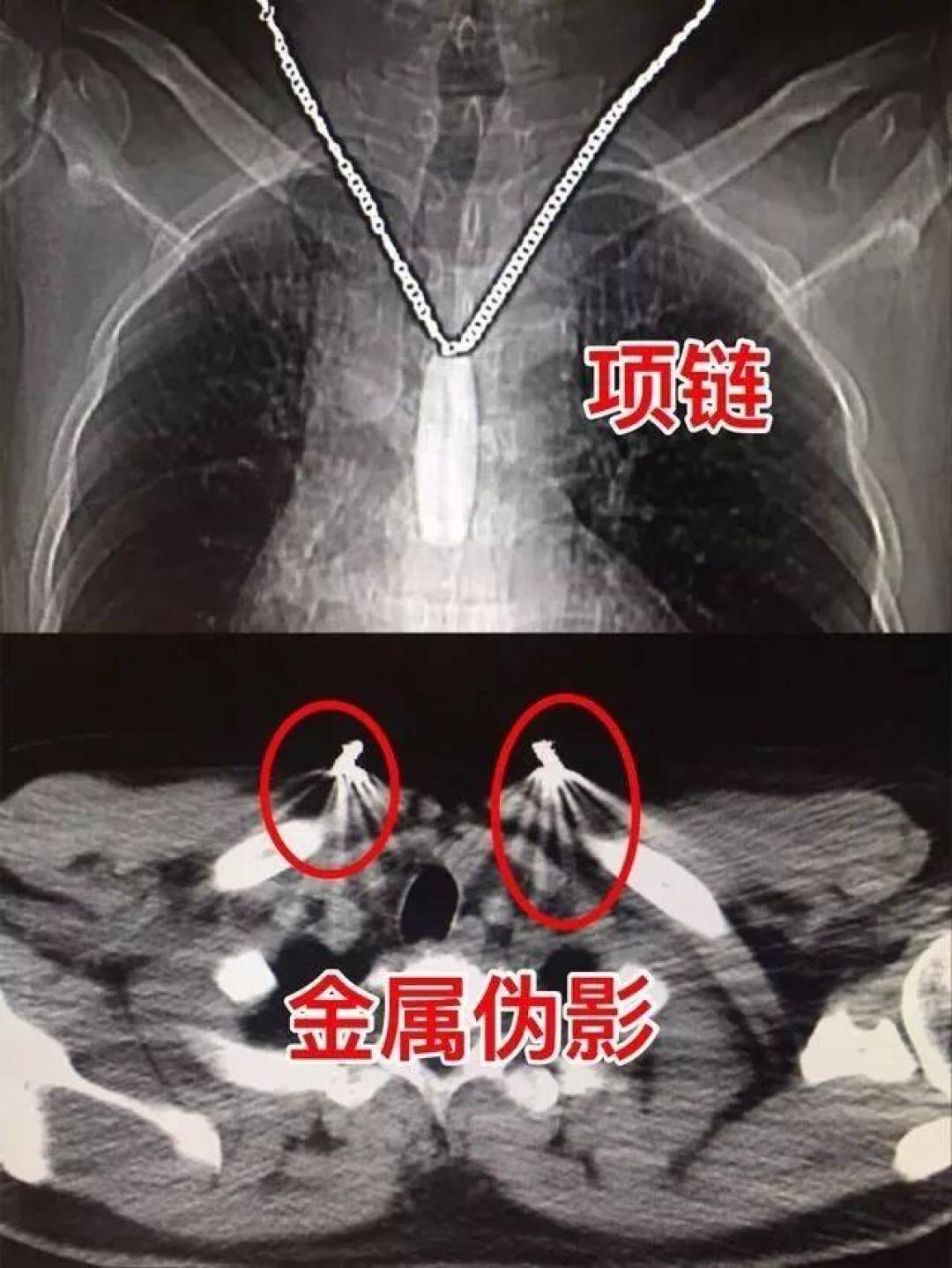 心脏放完支架后,还能做核磁共振检查吗?CT呢?医生说清注意事项