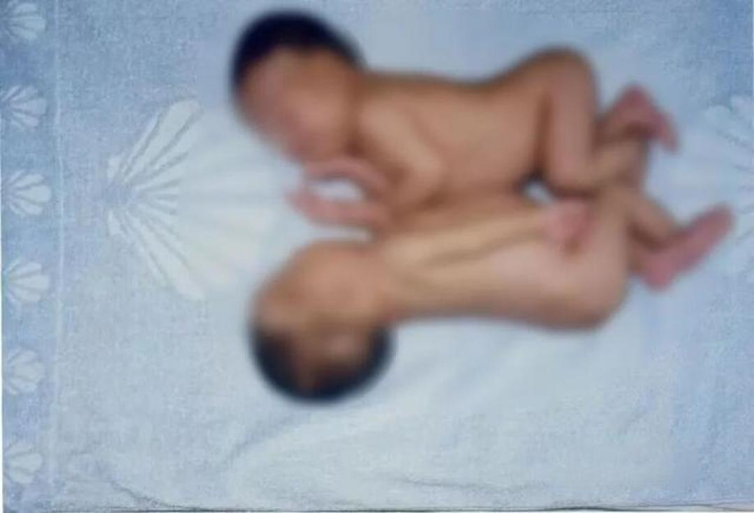 连体女婴分离28年后，当妈妈了！回到当年接受手术的医院生产，女儿小名叫……