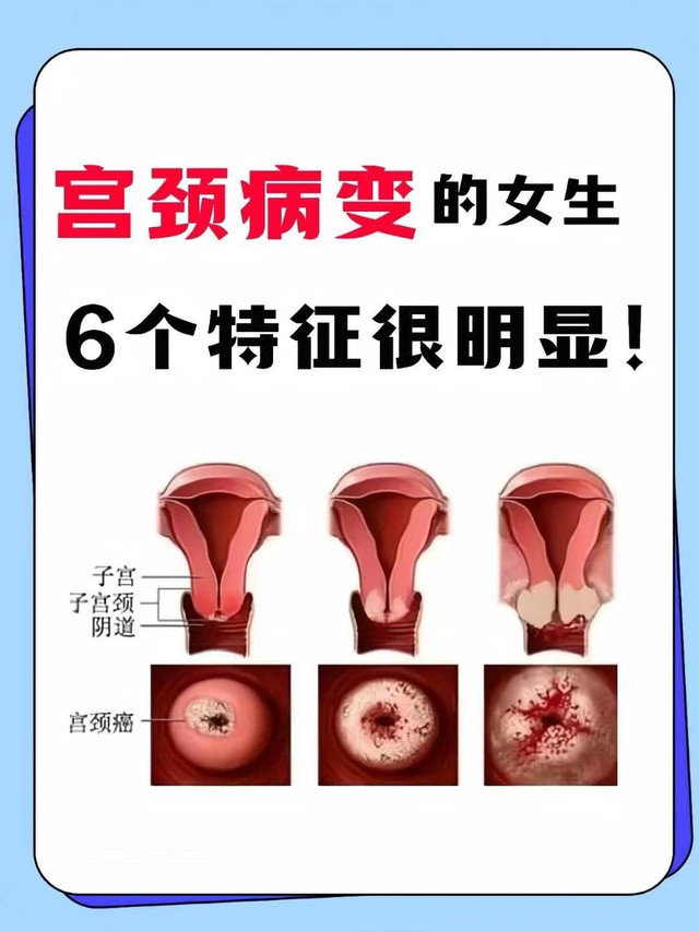 HPV感染6大特征！宫颈病变及时注意！