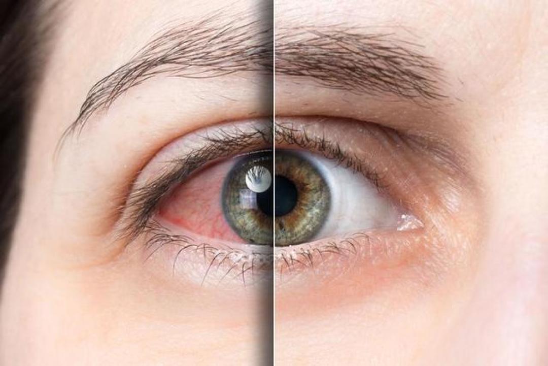 干眼症最大的问题，不是眼睛干涩，而是眼睛缺润了