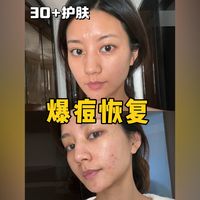 十年痘肌真心话！纯干货分享