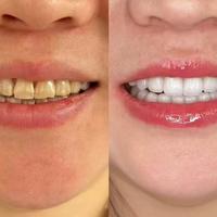 35-40岁美白护龈牙膏推荐｜附网备号，黄牙不踩雷