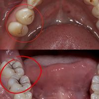 牙齿黑点别大意，分清原因少遭罪！