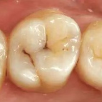 牙齿黑线超两成被误判！色素沉着与早期龋齿关键鉴别指南