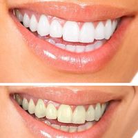 牙釉质受损别乱选牙膏！全家适配款实测，去黄抗敏还护牙