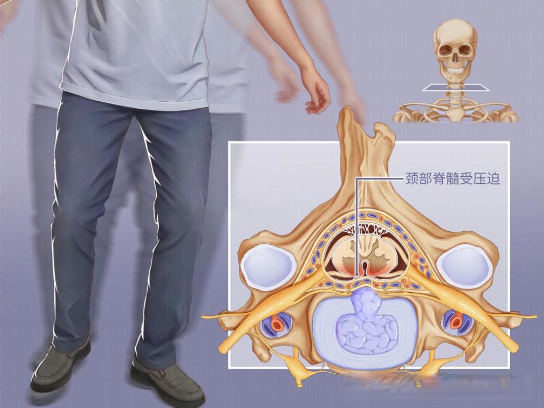 颈椎病的 6 种分型及典型症状