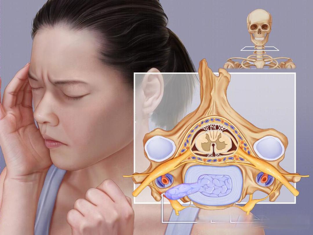 颈椎病的 6 种分型及典型症状