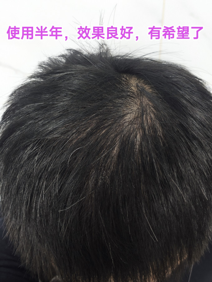 鲁南植发养发