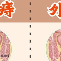 痔疮肉球脱出怎么办？做好这几点很重要！